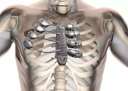 Could Titanium plates be left in the body safely?